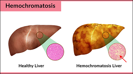 Hemochromatosis