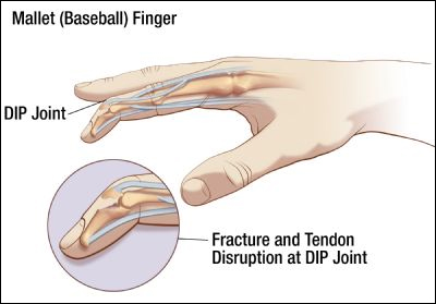 Herbal Remedies For Mallet Finger