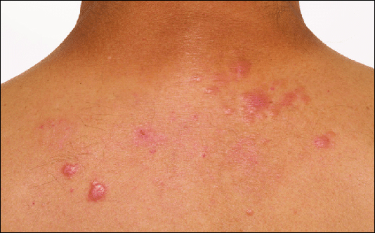 sarcoidosis