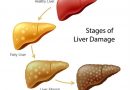 End Stage Liver Disease Or Meld Score – Ayurvedic View