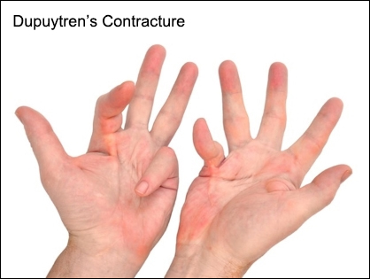Dupuytren's Contracture (Palmar fibromatosis)