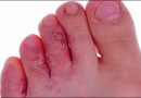 Tinea pedis or athlete’s foot