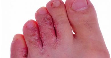 Tinea pedis or athlete’s foot