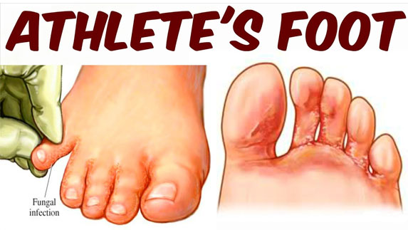 athlete's foot
