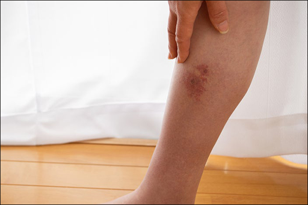cellulitis cellulitis