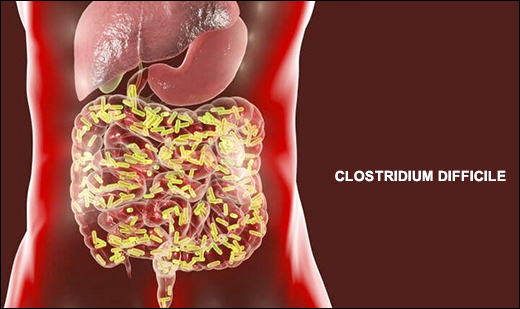 Clostridium Difficile Infection