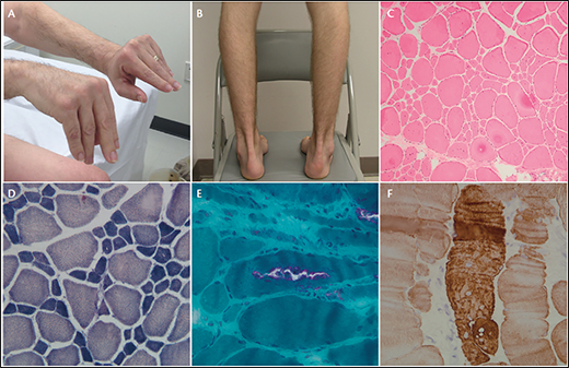 Gne Myopathy