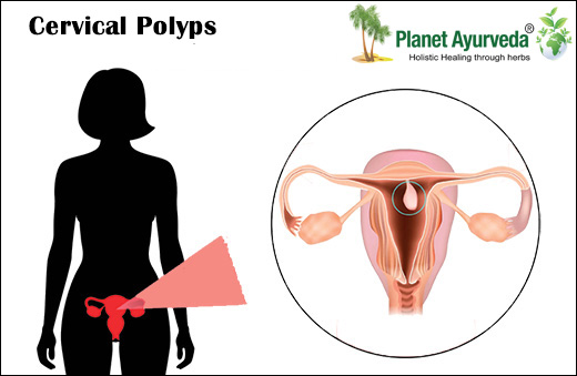 Cervical Polyps