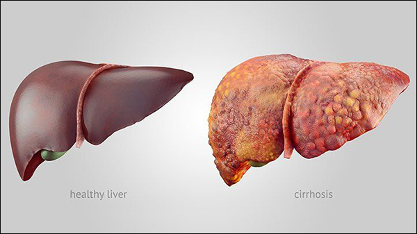 liver diseases