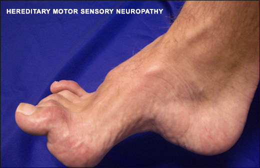 Hereditary Motor Sensory Neuropathy