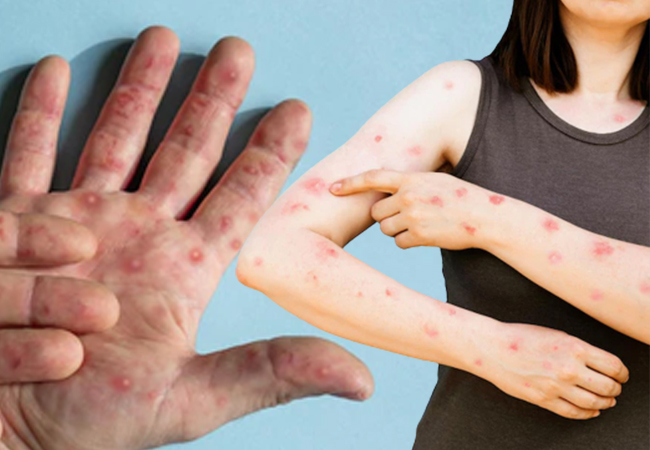 symptoms of monkey pox virus