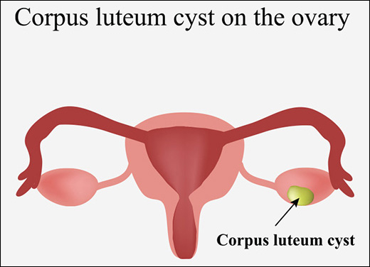 Corpus Luteum Cyst