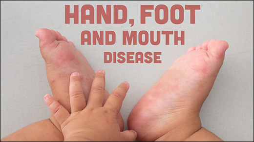Hand, Mouth and Foot Disease