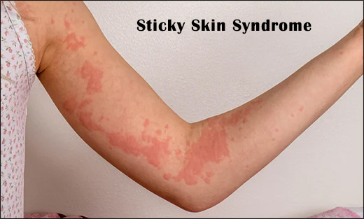 Sticky Skin Syndrome