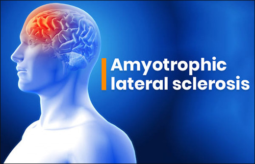 Amyotrophic Lateral Sclerosis