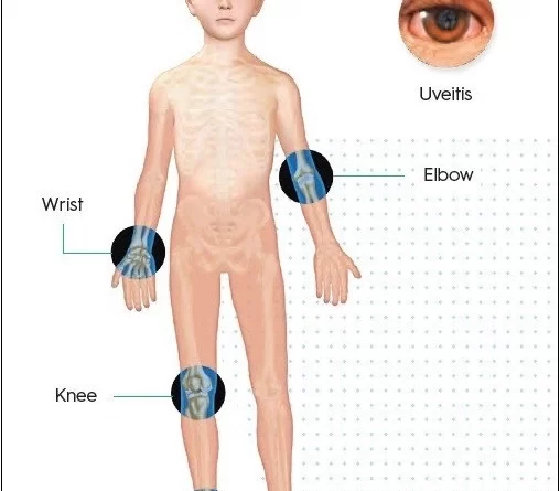 juvenile idiopathic arthritis