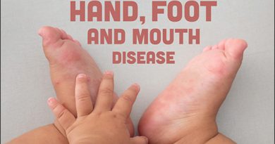 Management of Hand, Foot and Mouth disease