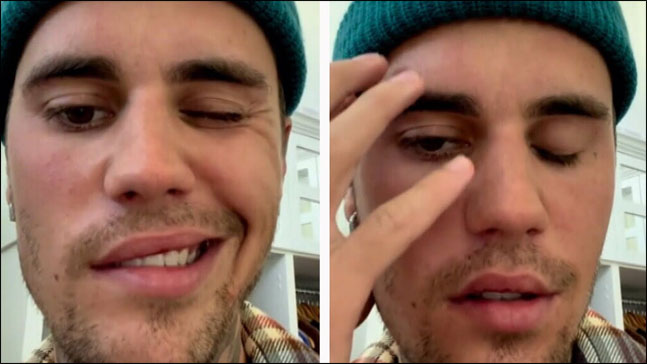 Management of Ramsay Hunt Syndrome Management of Ramsay Hunt Syndrome