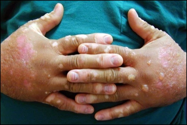 Phytophotodermatitis 