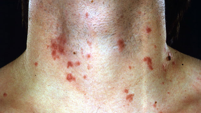 Phytophotodermatitis