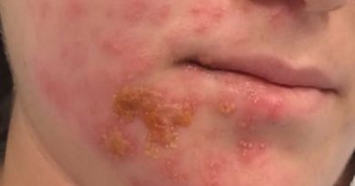 Ramsay Hunt Syndrome