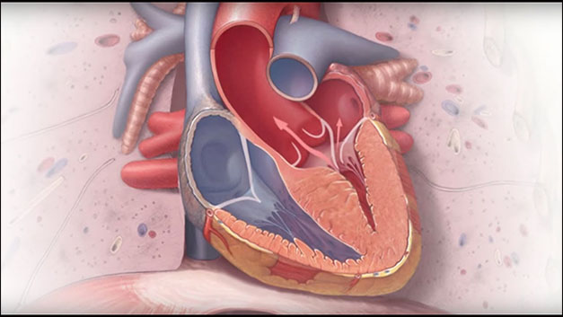 Hypertrophic Obstructive Cardiomyopathy