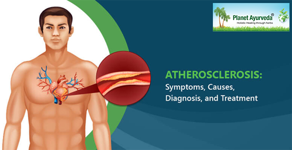 Treatment of Arteriosclerosis in Ayurveda