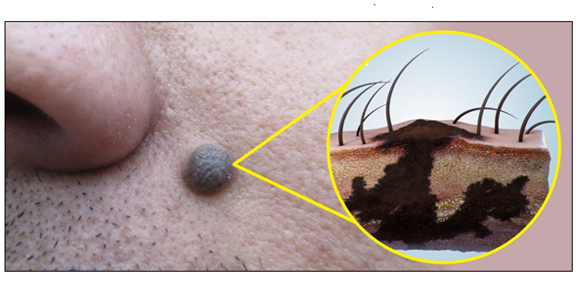 symptoms of Cherry Angioma