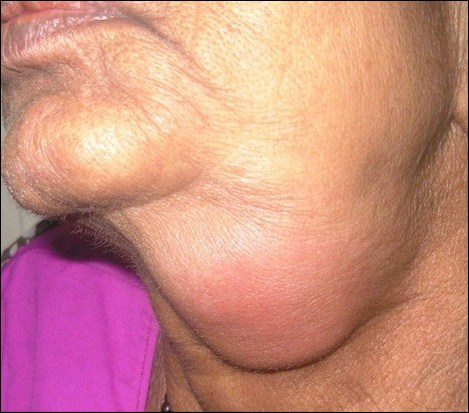 Sialadenitis and Sialadenosis