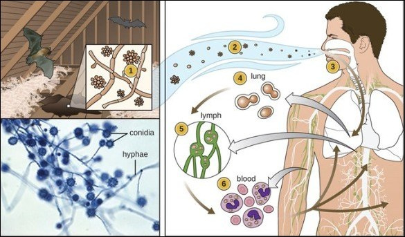 Blastomycosis