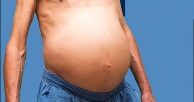 Chylous Ascites