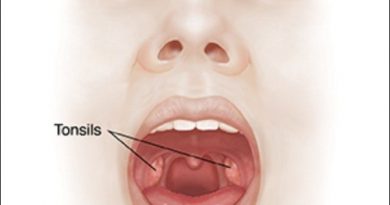 Tonsillitis