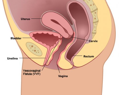 Urethrovaginal Fistula