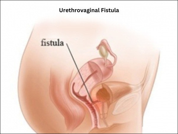 Urethrovaginal Fistula 