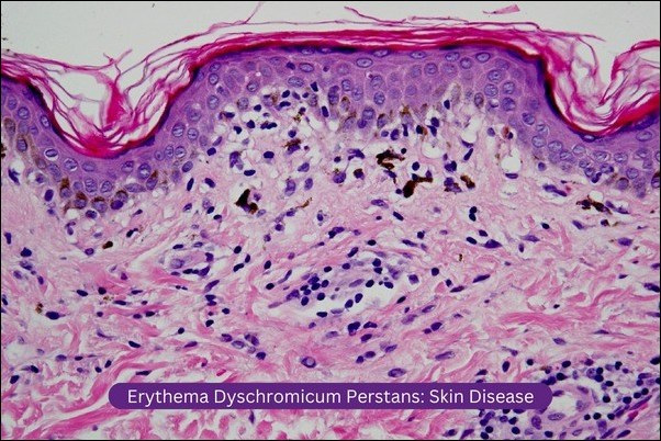 Erythema Dyschromicum Perstans