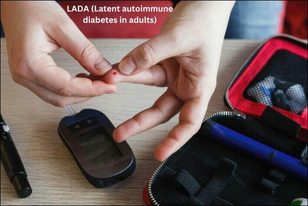 LADA (Latent autoimmune diabetes in adults)