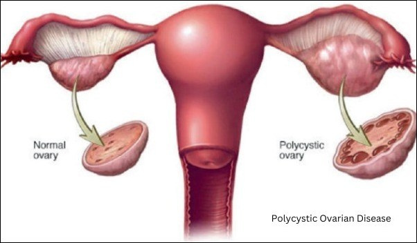 Polycystic ovarian disease 