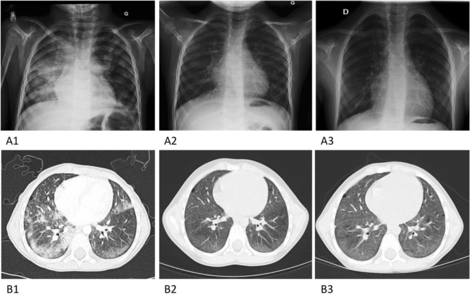 Savi (String-Associated Vasculopathy Infancy Dependent)