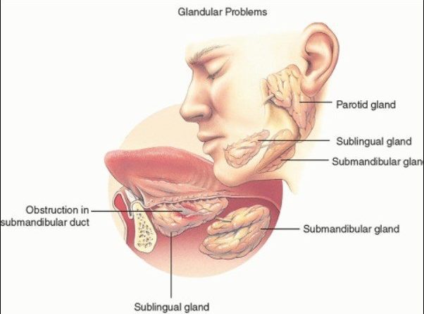 Sialadenitis and Sialadenosis