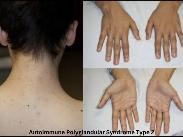Autoimmune Polyglandular Syndrome Type 2 or Schmidt's Syndrome