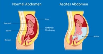 Ascites