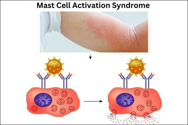 Mast cell activation syndrome 