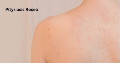 Pityriasis Rosea