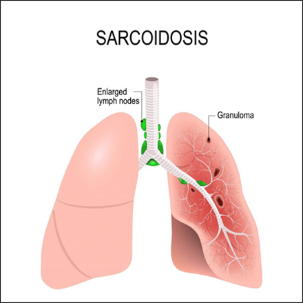 Sarcoidosis