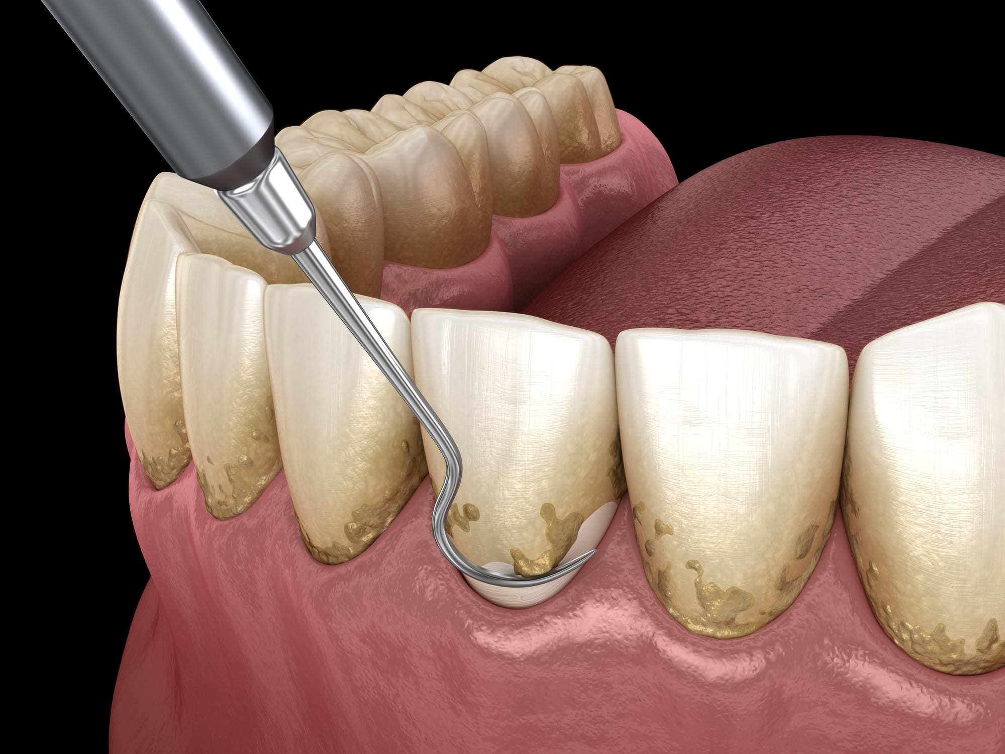 Caling Harmful For Dental Health