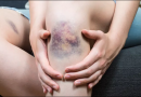 Idiopathic thrombocytopenia Purpura