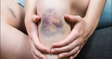 Idiopathic thrombocytopenia Purpura