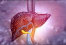 Fatty Liver And Its Ayurvedic Management Liver
