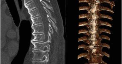 Diffuse idiopathic skeletal hyperostosis