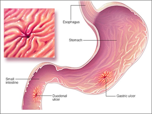 Duodenal ulcers